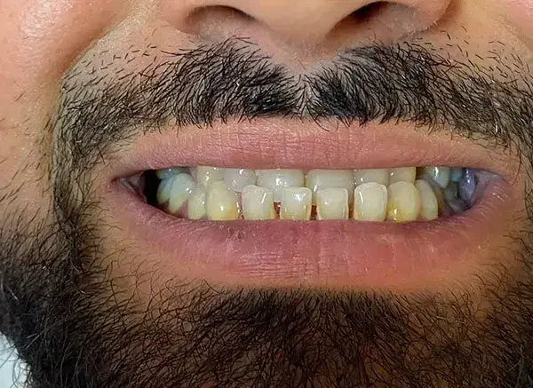 Önce